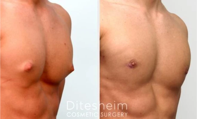 Male gynecomastia surgery before and after showing flatter chest contour | Ditesheim Cosmetic Surgery Charlotte