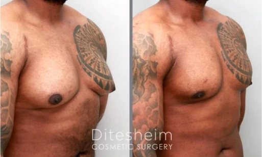 Before and after gynecomastia surgery results showing improved, natural chest contour | Ditesheim Cosmetic Surgery Charlotte