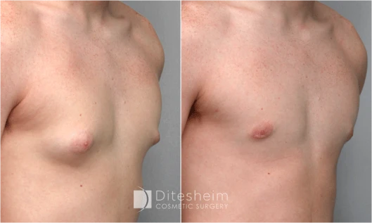 Male gynecomastia surgery before and after showing flatter chest contour