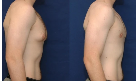 Gynecomastia surgery before and after results showing a more defined, masculine chest | Ditesheim Cosmetic Surgery Charlotte