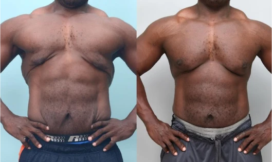 efore and after photo showing gynecomastia surgery transformation with firm, sculpted chest | Charlotte plastic surgeon