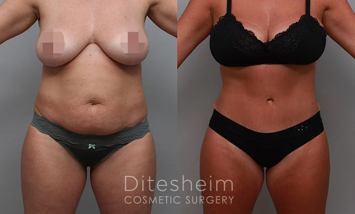 Before and after mommy makeover showing flatter abdomen and lifted breasts.