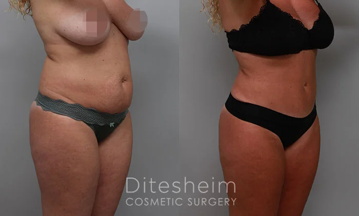 Mommy makeover showing restored body shape and tighter abdomen.