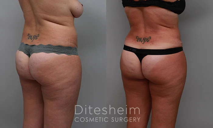 Ditesheim Cosmetic Surgery mommy makeover with tummy tuck and breast lift results.