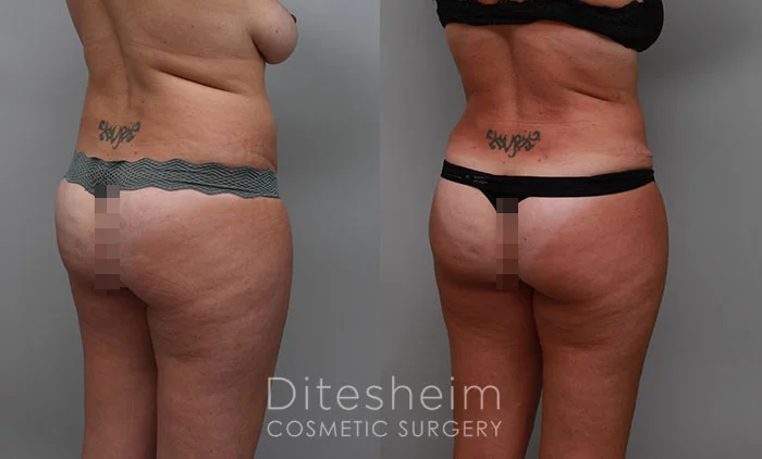 Ditesheim Cosmetic Surgery mommy makeover with tummy tuck and breast lift results.