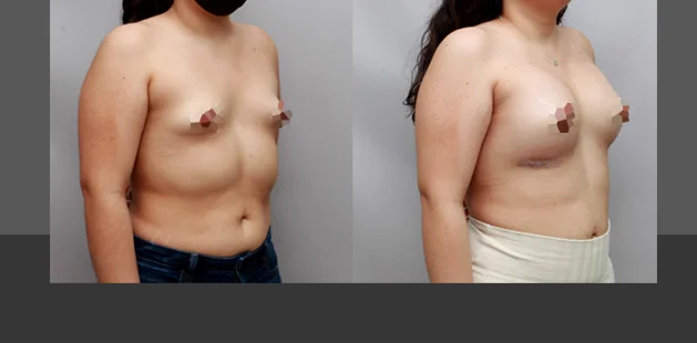 Before and after image of breast implant surgery showing enhanced size and shape.