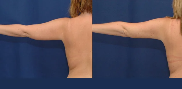 Arm lipedema surgery results showing smoother contour and decreased fat buildup