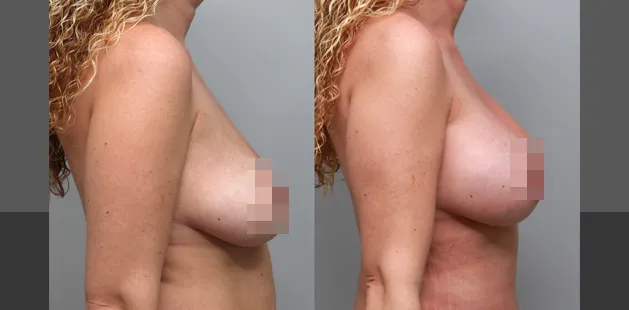 Before and after breast augmentation results at plastic surgery practice in Charlotte, NC.