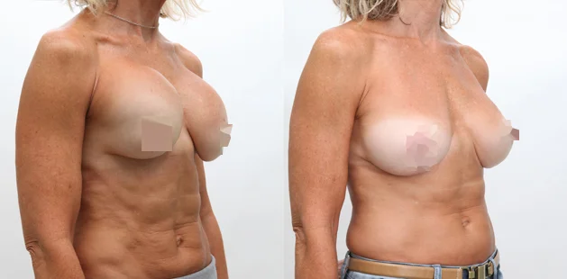 42 yr woman with capsular contraction after breast implants shown before and after removing implants and capsules and breast lift obliquepsd copy