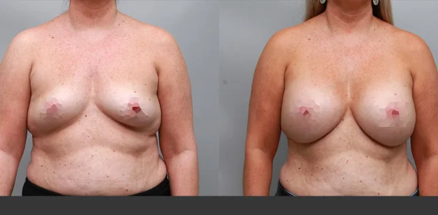 Ditesheim Cosmetic Surgery Charlotte NC breast augmentation outcome for 45-year-old patient, height 5'5", weight 185 lbs