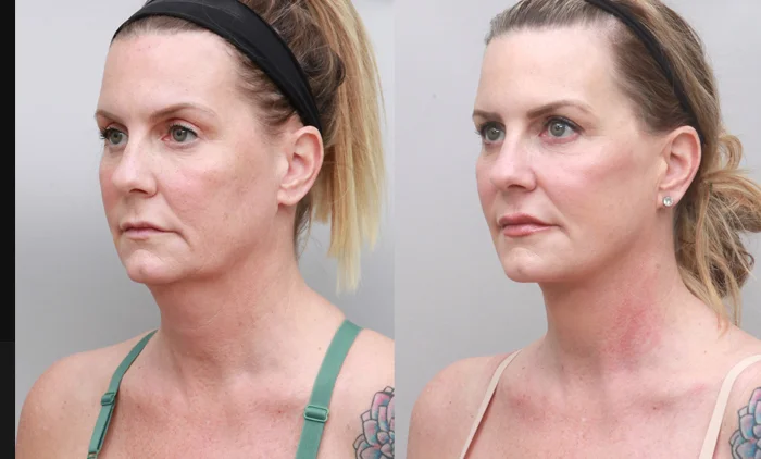 Before and after facelift and neck lift showing lifted features and smoother neckline