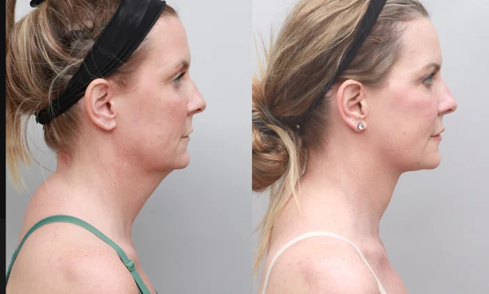 Before and after facial rejuvenation highlighting reduced sagging and restored skin tone | Facelift results at Ditesheim Cosmetic Surgery Charlotte