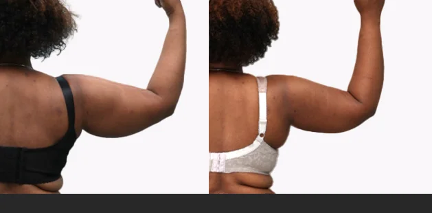 Before and after arm lipedema surgery showing smoother, more toned upper arms and reduced swelling | Arm lipedema treatment results at Ditesheim Cosmetic Surgery Charlotte