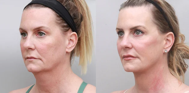 Before and after facelift and eyelid surgery showing refreshed, more youthful facial balance | Plastic surgery results at Ditesheim Cosmetic Surgery Charlotte