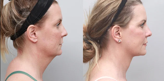 Facial surgery before and after at Ditesheim Cosmetic Surgery Charlotte