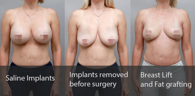 Before and after breast implant revision showing saline implants, implant removal, and breast lift with fat grafting at Ditesheim Cosmetic Surgery.
