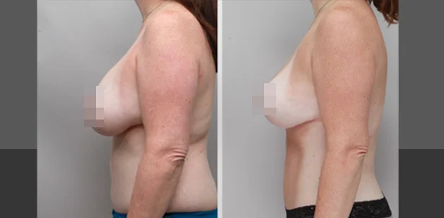 50 yr woman after removing breast implants with breast lift oblique2 copy