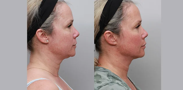 Before and after Renuvion neck lift showing improved jawline definition and tighter neck contour – Ditesheim Cosmetic Surgery Charlotte NC.
