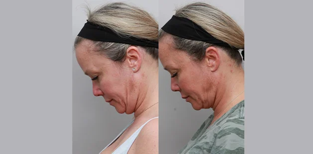 Before and after Renuvion neck lift showing tightened skin, reduced sagging, and smoother jawline contour – Ditesheim Cosmetic Surgery Charlotte NC.