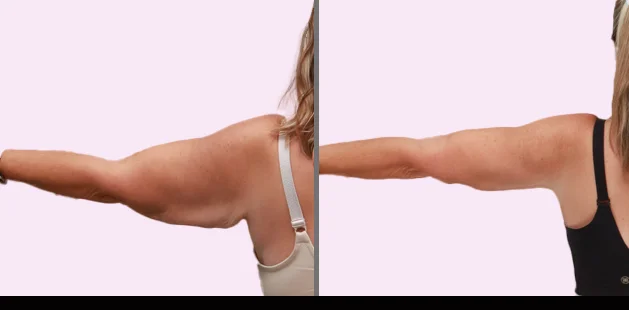 Post-surgery arm lipedema improvement with firmer tone and visible reduction in swelling | Ditesheim Cosmetic Surgery Charlotte