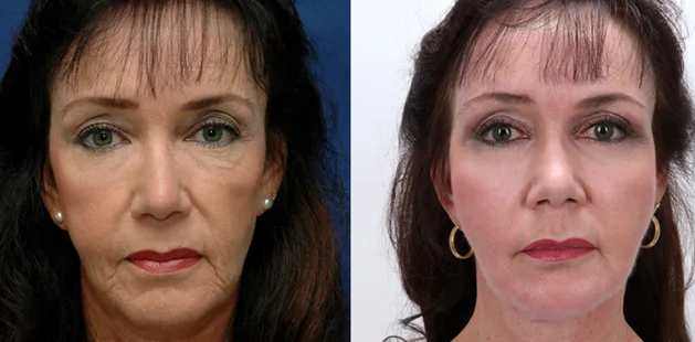 Facial plastic surgery results at Ditesheim Cosmetic Surgery Charlotte