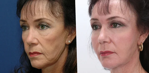 Before and after facelift showcasing lifted midface, smoother skin, and enhanced facial harmony | Facial plastic surgery results at Ditesheim Cosmetic Surgery Charlotte