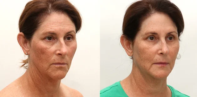 Before and after mini facelift demonstrating natural rejuvenation and refined contours | Facial surgery before and after at Ditesheim Cosmetic Surgery Charlotte