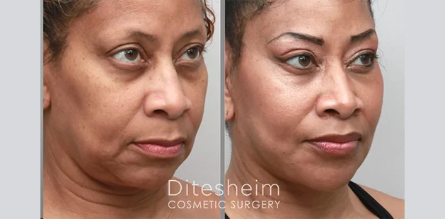 Plastic surgery results at Ditesheim Cosmetic Surgery Charlotte