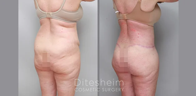 Before and after buttock lift and augmentation showing smoother skin, lifted contours, and enhanced lower body shape | Ditesheim Cosmetic Surgery Charlotte