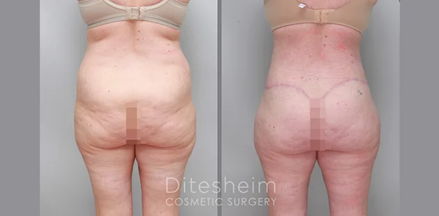 Tummy tuck, liposuction and BBL results for 46-year-old 5’11” 120 lbs at Ditesheim Cosmetic Surgery Charlotte North Carolina