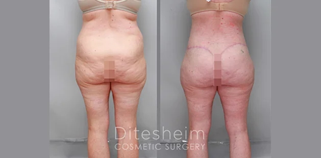 Post-weight loss tummy tuck 360 results showing firmer, more defined midsection and lower body