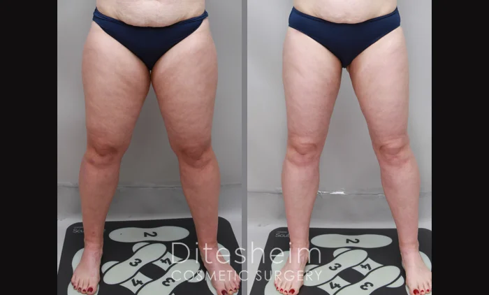 Thigh lipedema before and after results highlighting improved shape and reduced fullness | Ditesheim Cosmetic Surgery Charlotte