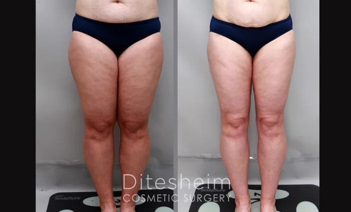 Before and after lipedema treatment showing reduced swelling and smoother leg contours | Ditesheim Cosmetic Surgery Charlotte