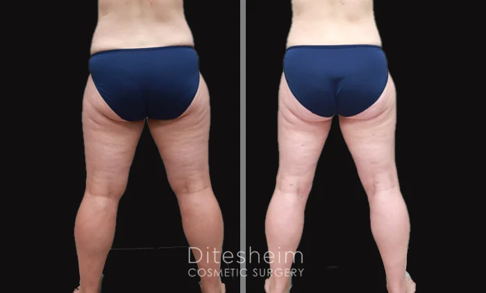 Before and after lipedema treatment showing reduced swelling and smoother leg contours | Ditesheim Cosmetic Surgery Charlotte