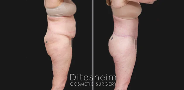 After weight loss tummy tuck 360 transformation showing smoother, tightened body contours | Ditesheim Cosmetic Surgery Charlotte