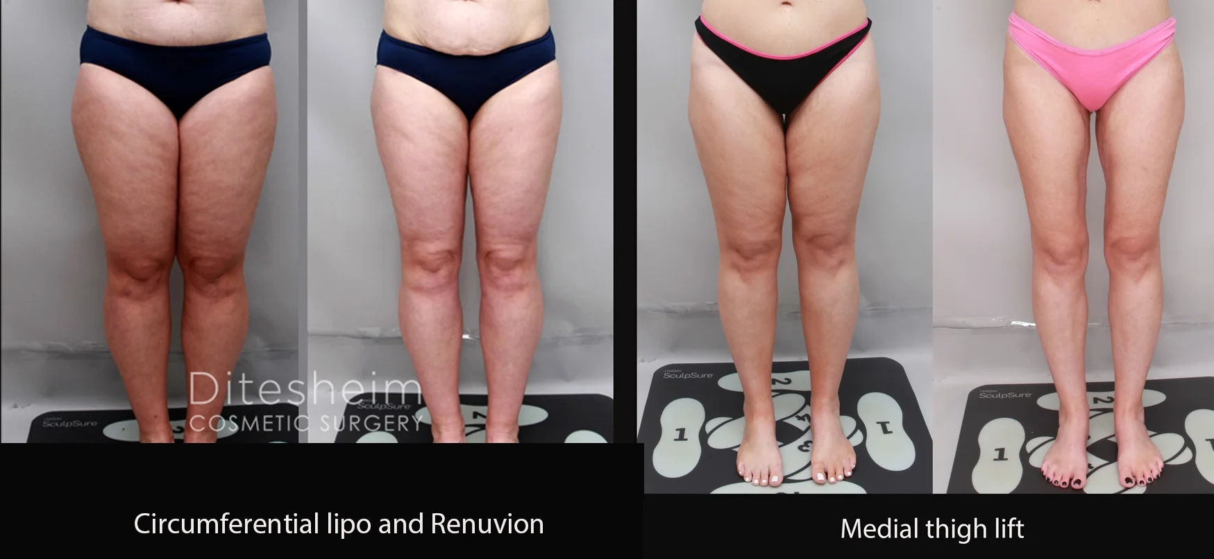 Thigh lipedema before and after results highlighting improved shape and reduced fullness | Ditesheim Cosmetic Surgery Charlotte