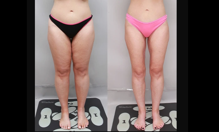 Before and after thigh lift highlighting smoother skin and firmer thigh contour | Thigh lift results at Ditesheim Cosmetic Surgery Charlotte