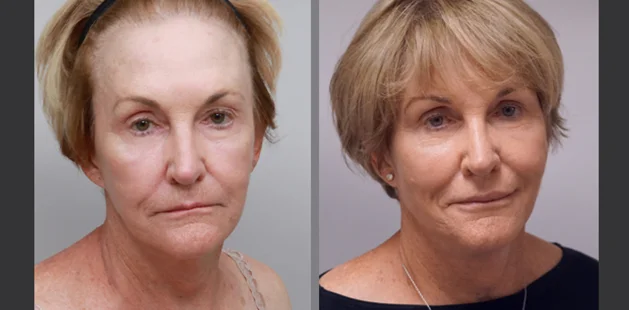 Before and after facial plastic surgery showing smoother complexion and youthful lift | Cosmetic facial procedure results at Ditesheim Cosmetic Surgery Charlotte