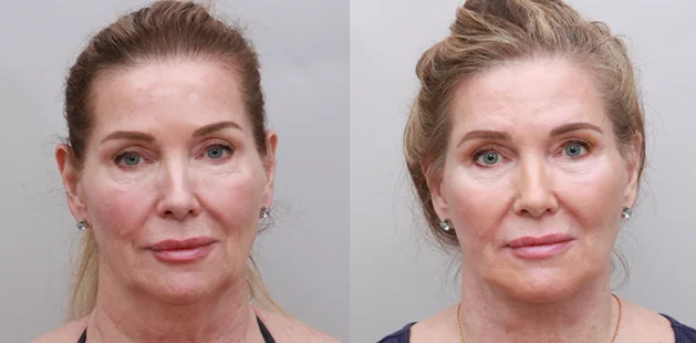 Before and after facelift on a 69-year-old woman showing lifted cheeks, smoother skin texture, and a more youthful facial contour.