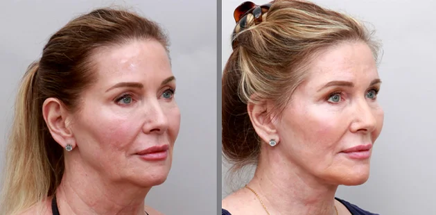 Before and after facelift on a 69-year-old woman showing lifted cheeks, smoother skin texture, and a more youthful facial contour – Ditesheim Cosmetic Surgery Charlotte, NC.