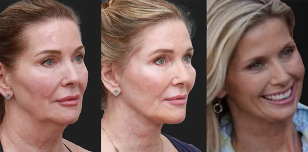 Before and after facelift and deep plane neck lift with fat grafting, showing enhanced jawline definition and natural facial rejuvenation – Ditesheim Cosmetic Surgery Charlotte, NC.
