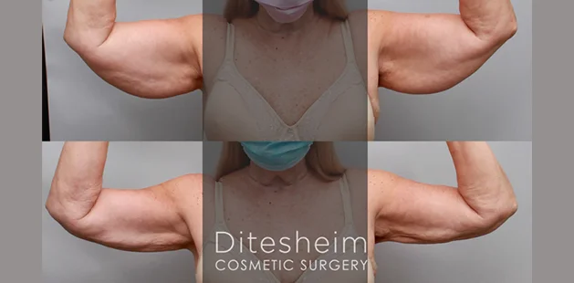 Before and after arm lipedema surgery showing smoother, more toned upper arms and reduced swelling | Arm lipedema treatment results at Ditesheim Cosmetic Surgery Charlotte