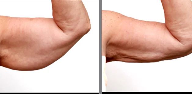 Arm lipedema treatment results at Ditesheim Cosmetic Surgery Charlotte
