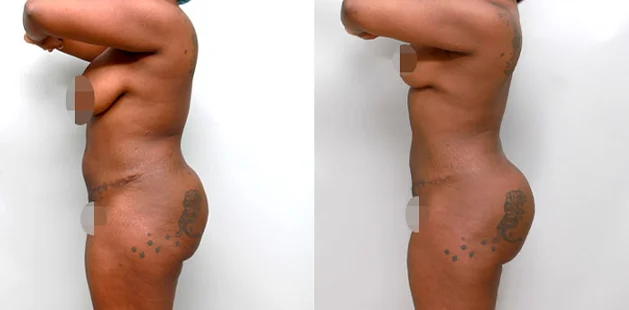 Before and after tummy tuck 360 results after weight loss showing enhanced waistline and improved skin tightness