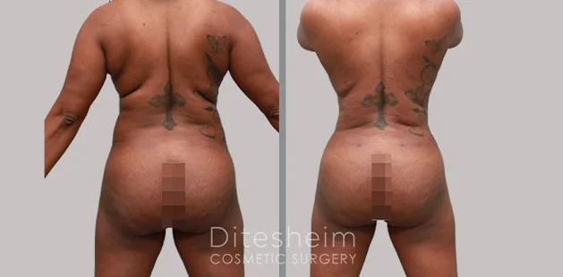 Post-weight loss tummy tuck 360 results showing firmer, more defined midsection and lower body | Ditesheim Cosmetic Surgery Charlotte