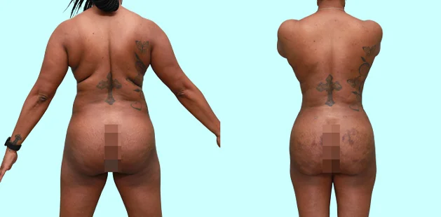 Age 42 patient 5'4" 165 lbs post liposuction, Renuvion and BBL at Ditesheim Cosmetic Surgery Charlotte NC, enhanced waist contour