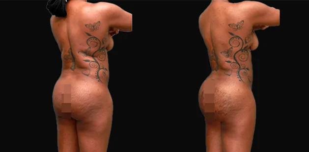 360 tummy tuck after major weight loss revealing smoother back and lifted body contours | Ditesheim Cosmetic Surgery Charlotte