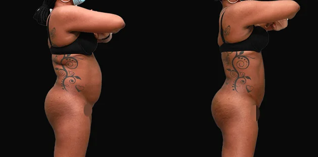 Post-weight loss tummy tuck 360 results showing firmer, more defined midsection and lower body
