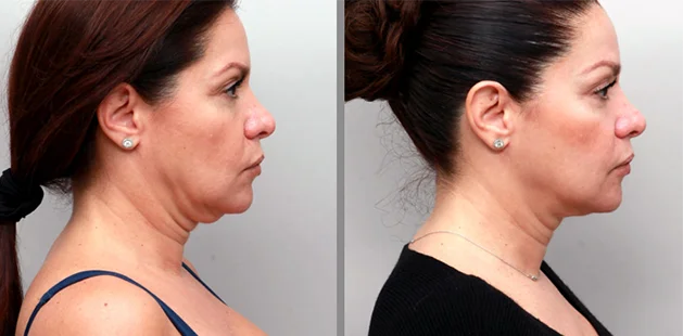 Before and after Renuvion treatment on a 57-year-old woman, highlighting a smoother neckline, tighter jawline, and more youthful lower face.