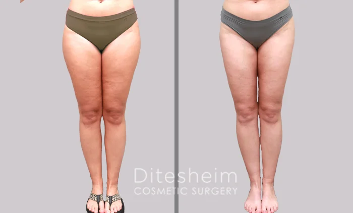 Before and after thigh lipedema surgery showing smoother, slimmer leg contours and improved symmetry